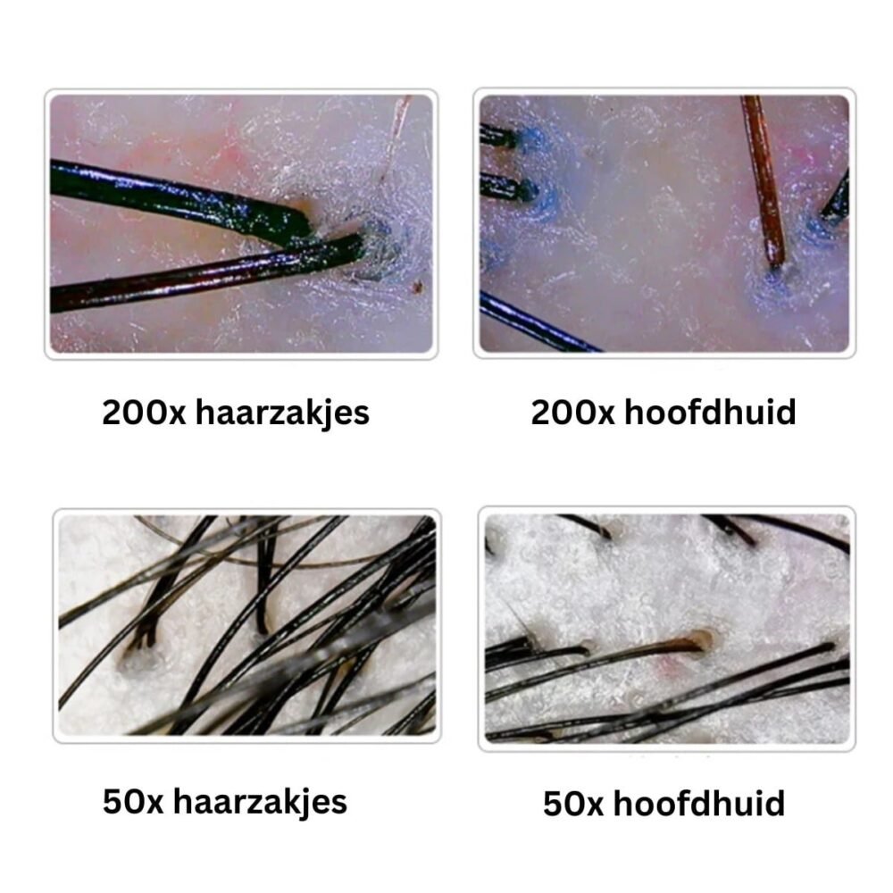 Hoofdhuid Analyse Apparaat